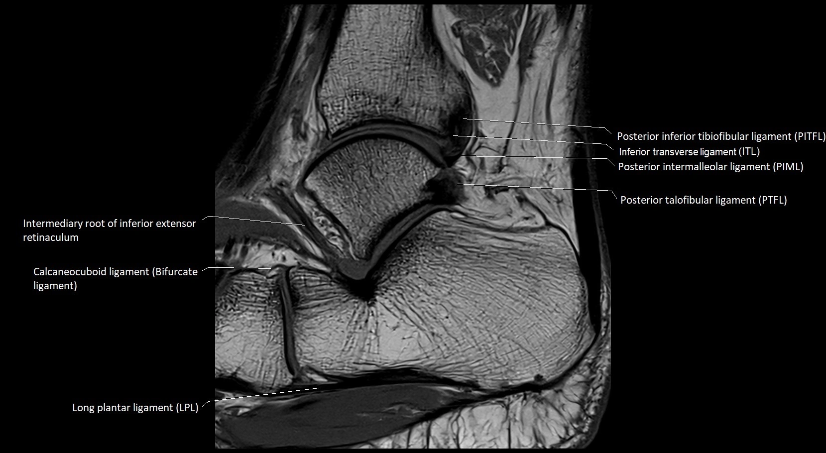 MRI ankle ligaments anatomy sagittal 3T image 19.webp